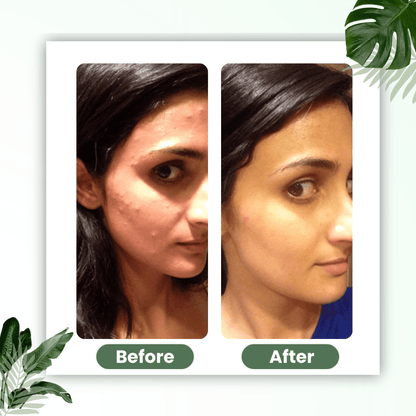 🔥Hot Sale 50% OFF🔥Natravor®  Green Tea Deep Cleanse Mask Stick ACE 1