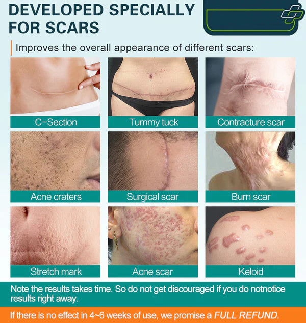 🔥Hot Sale🔥Scar Remove – Medical Grade Scar Spray(For example Acne Scars, Surgical Scars and Stretch Marks ⚡️⚡️⚡️)