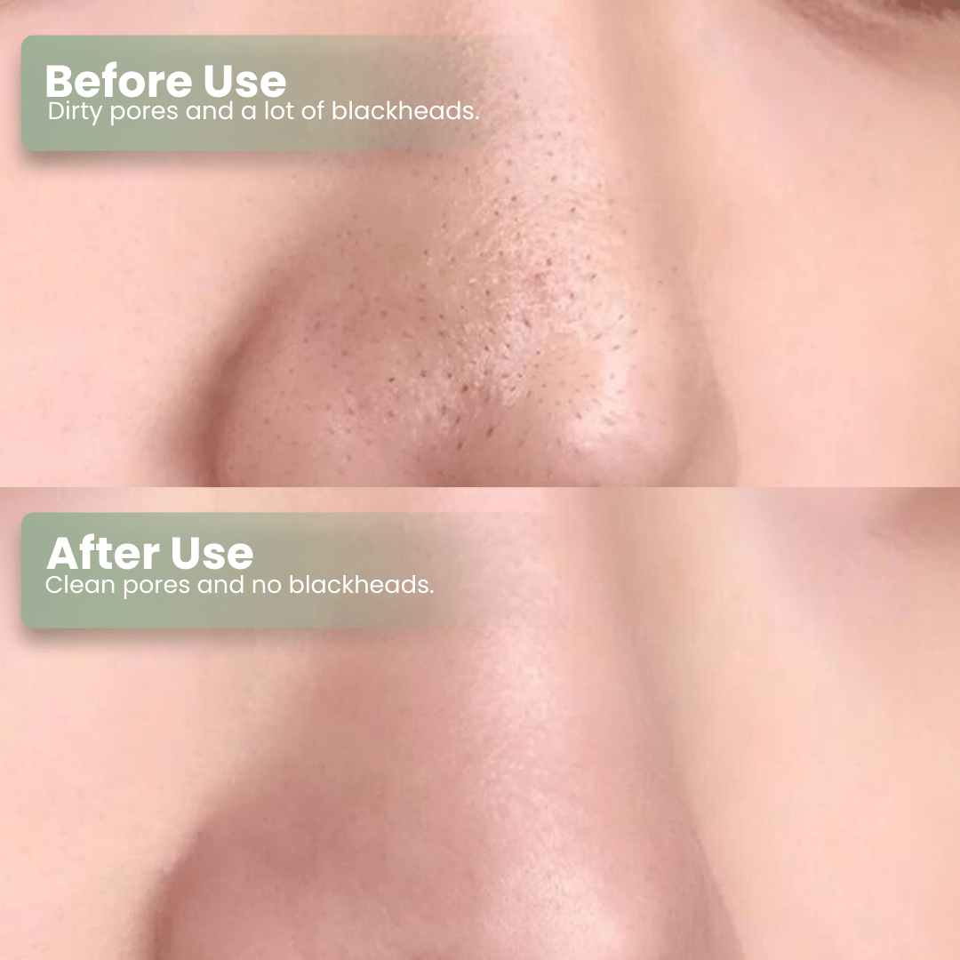 🔥Hot Sale 50% OFF🔥Natravor®  Green Tea Deep Cleanse Mask Stick ACE 1